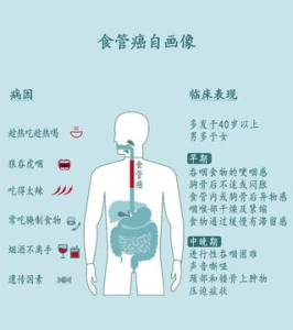 食管与食管癌-网络宝藏